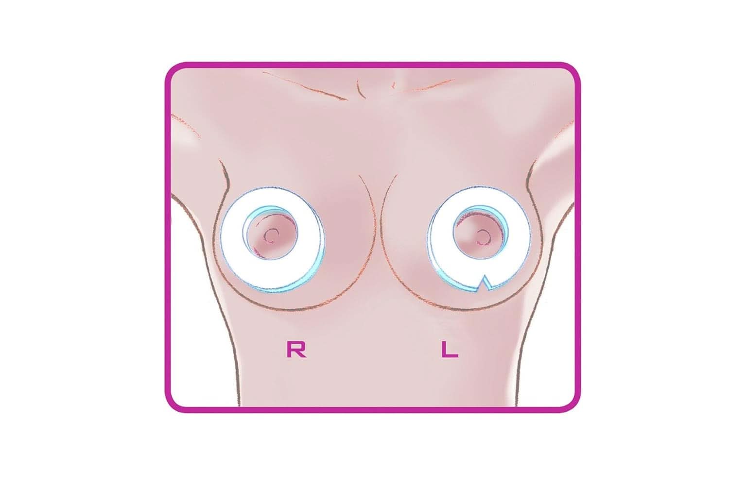 ELANEE Brust-Ringe, Schutz Der Brustwarze Bh-Kontakt Durch Hohllagerung, Ideal Bei Wunden, Entzündeten Brustwarzen Durch Stillen, 10 Stück (222-00) Příslušenství Jídlo a kojení Bebe Naty Shop