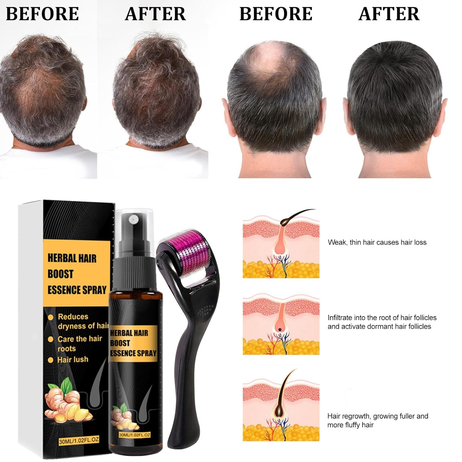 Kit de tratament avansat pentru creșterea părului 30ml 2PCS, spray pentru creșterea părului, set de role și esențe pentru creșterea părului, ser pentru creșterea părului, împotriva căderii părului, ser pentru creșterea avansată a părului Ingrijirea parului Naty Shop